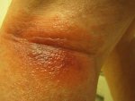 Spider bite.JPG